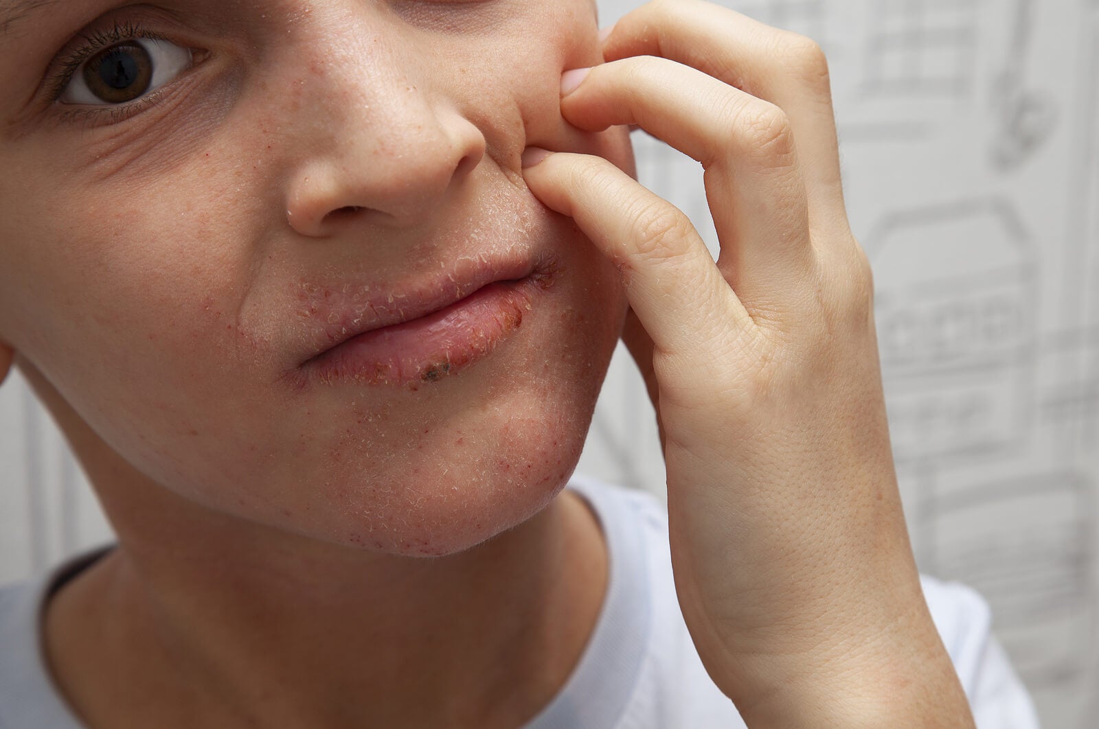 Dermatitis atópica en el rostro.