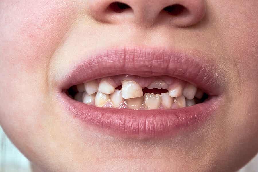 Cómo debemos conservar un diente fuera de la boca