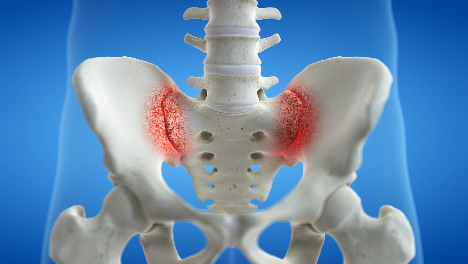 Hipermovilidad de la articulación sacroilíaca con dolor por artritis.