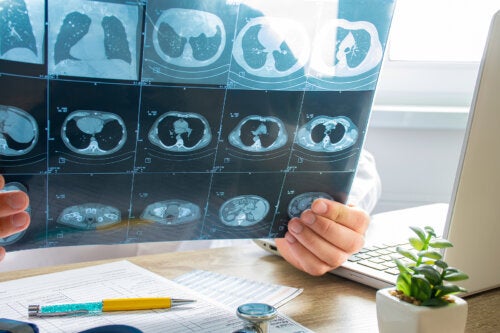 Embolia pulmonar: síntomas y tratamiento