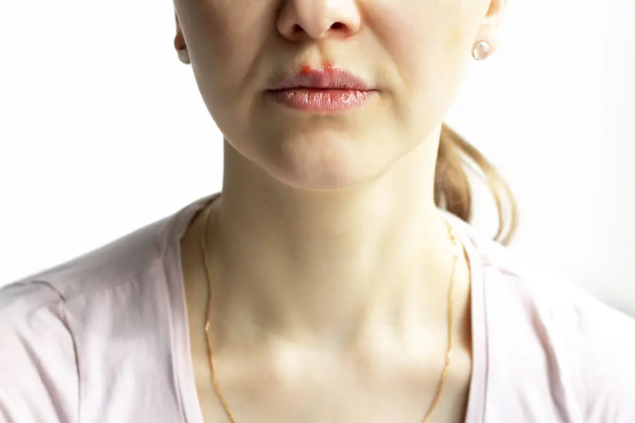 Mujer con pénfigo vulgar