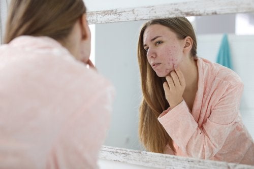 Acné hormonal: causas y tratamientos