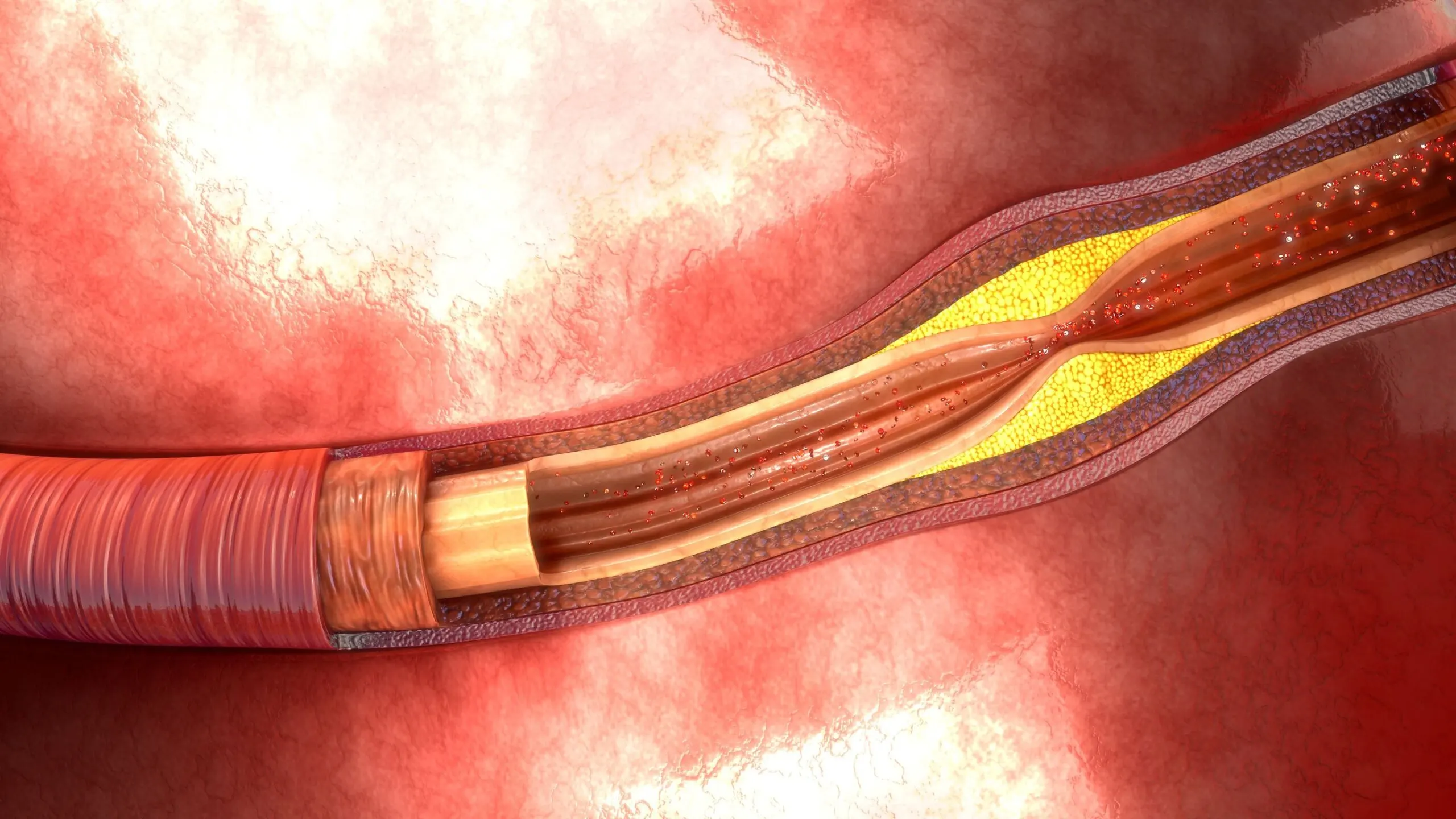 La enfermedad arterial periférica puede producirse por la aterosclerosis.