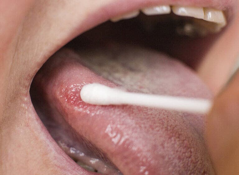 Puntos negros en la lengua, ¿en qué consisten?