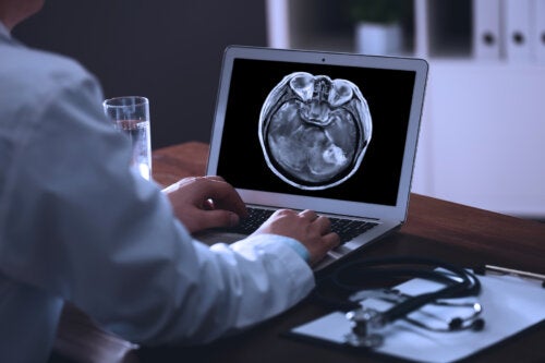 Metástasis cerebral: ¿qué es y cuál es su tratamiento?