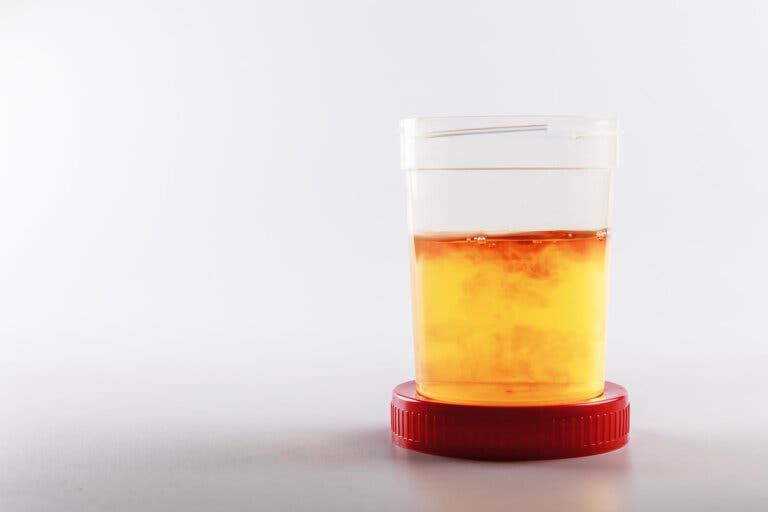 Hematuria, ¿cuáles son sus síntomas y causas?