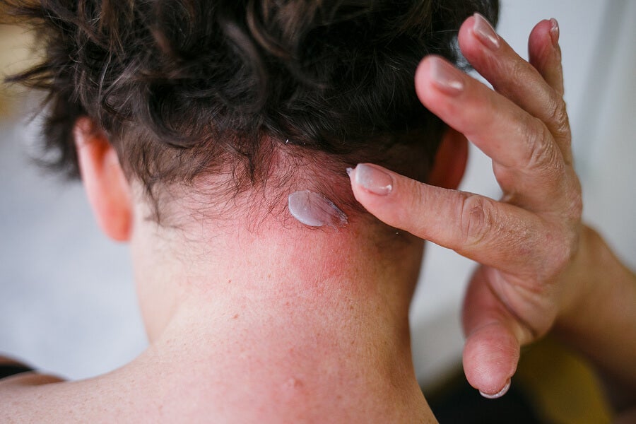 Dermatitis seborreica: síntomas y tratamiento Mejor con Salud