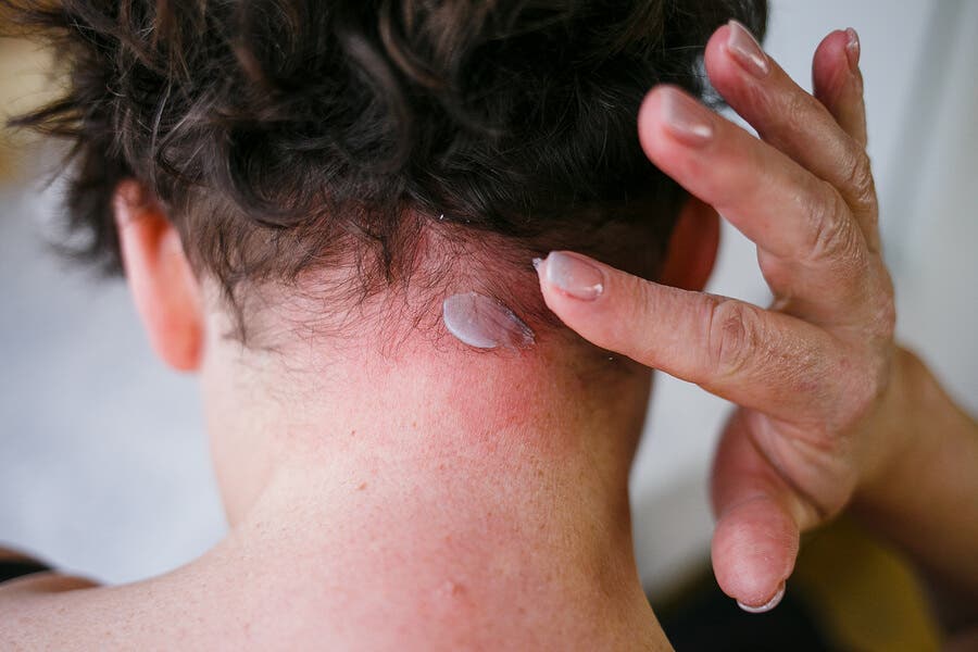 Dermatitis seborreica: síntomas y tratamiento