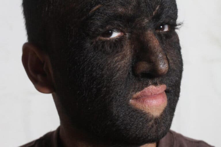Hipertricosis o síndrome del hombre lobo