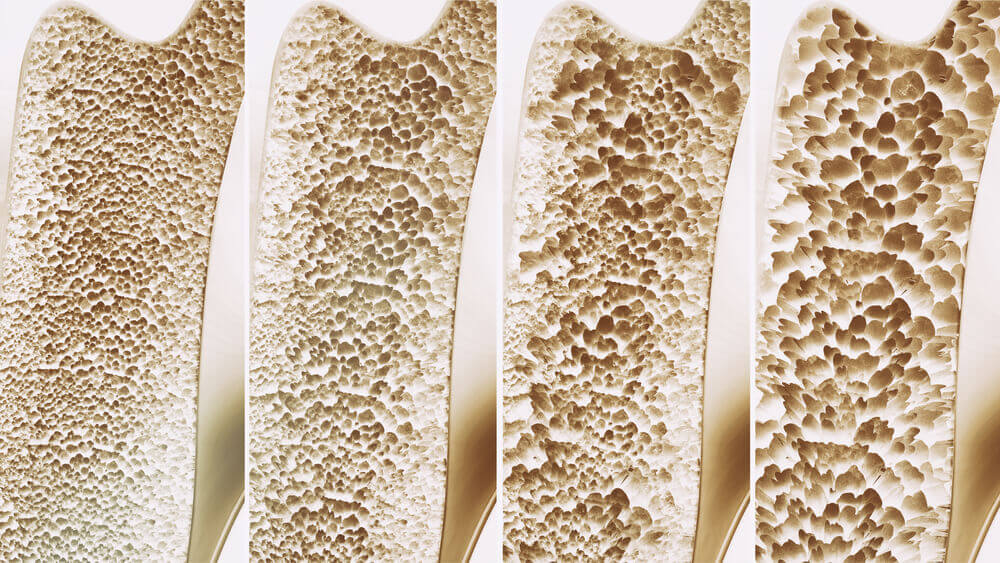 Bones with osteoporosis.