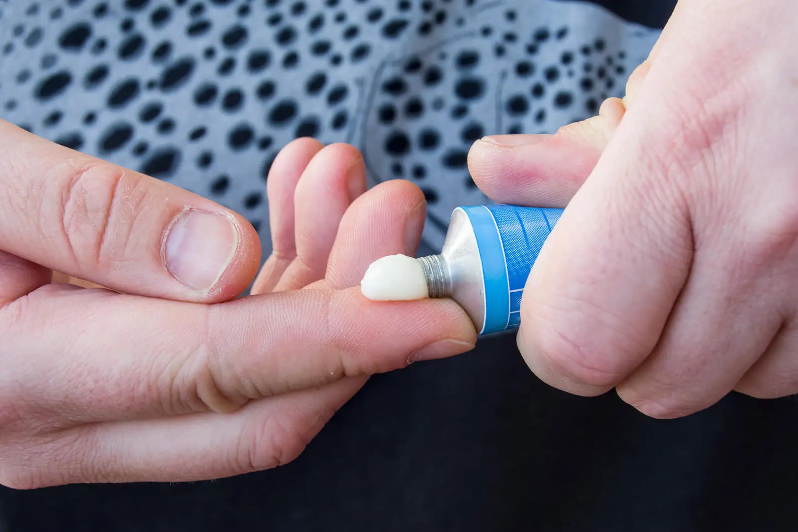¿Qué es la betametasona dipropionato o Diproderm?
