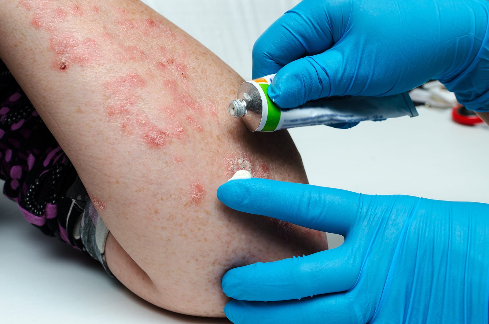 Productos de uso tópico con propiedades antiinflamatorias y antifúngicas pueden ayudar en el tratamiento de la dermatitis seborreica.