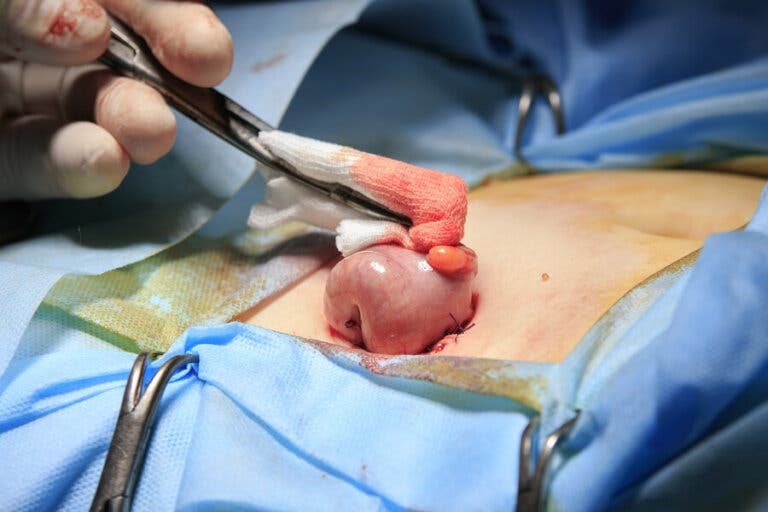 Colostomía, ¿qué es?
