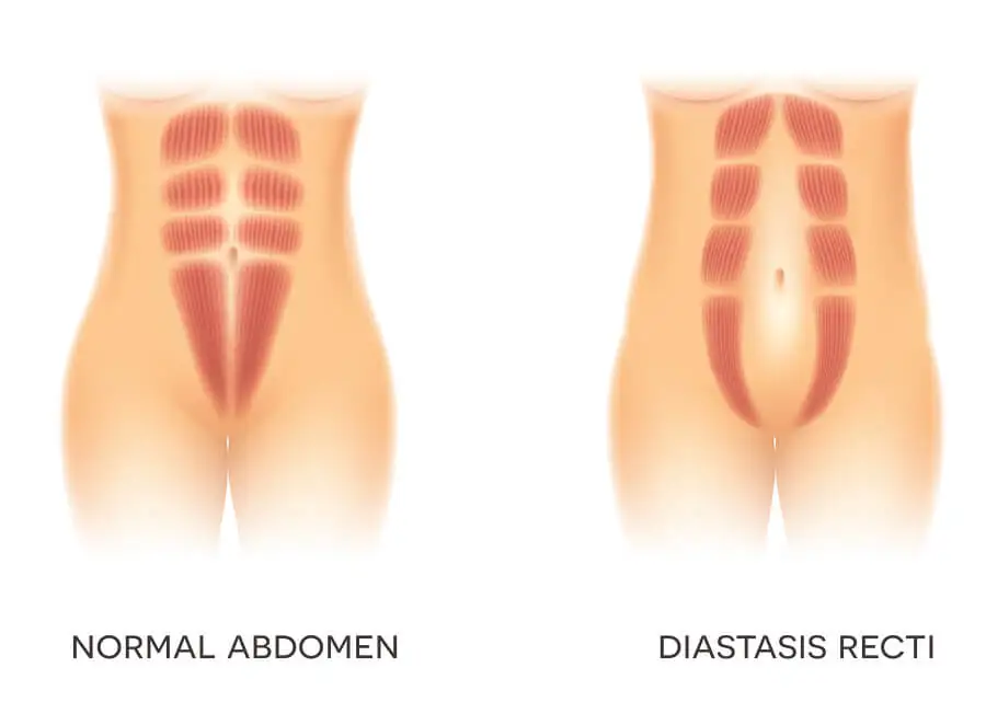 ¿Qué es la diástasis abdominal?
