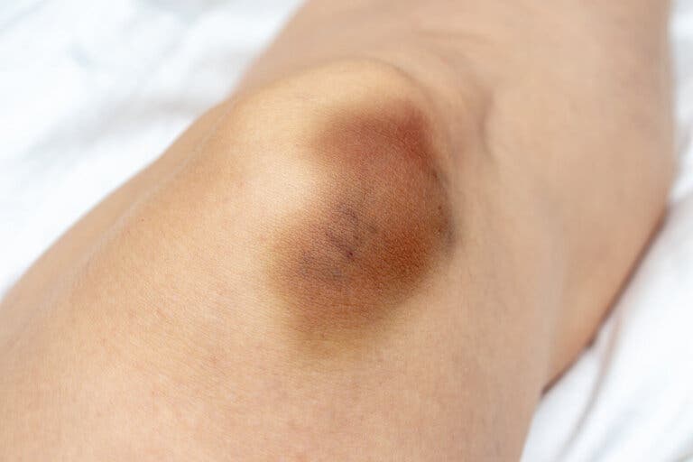 ¿Qué es una equimosis?