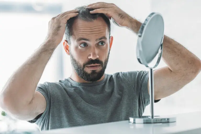 Alopecia androgénica: síntomas, causas y tratamiento