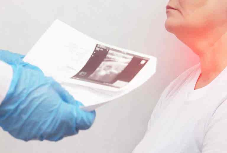 Nódulos tiroideos: síntomas y causas