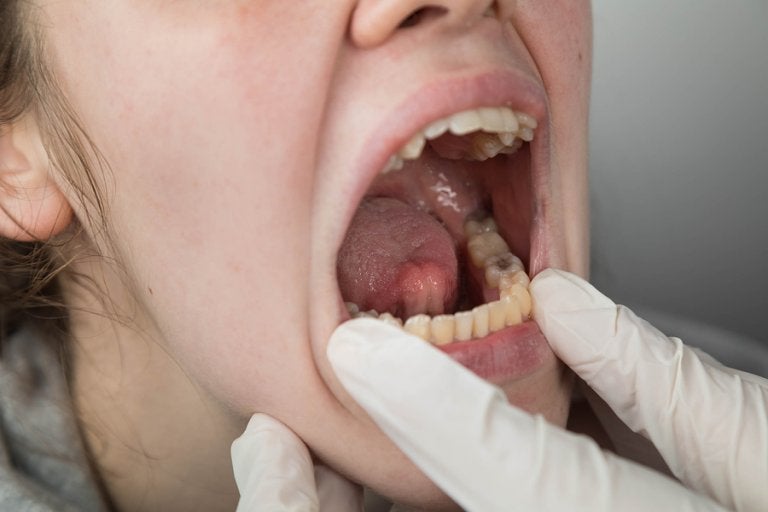 Factores de riesgo del cáncer oral