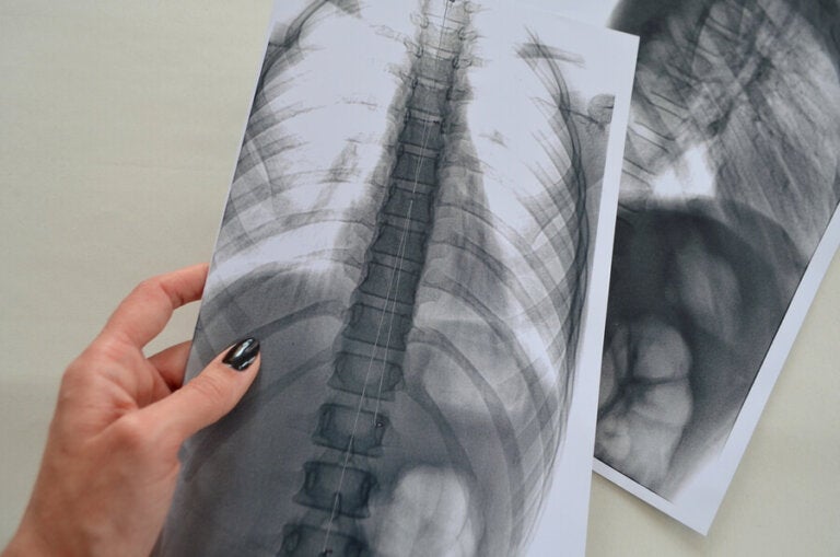 Radiografía lumbar: ¿debo preocuparme?