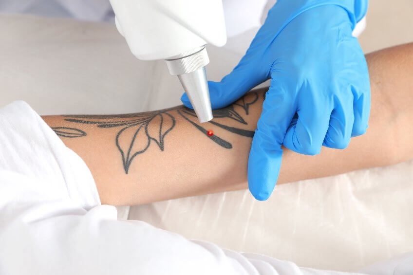 Remover tatuajes