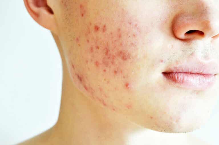 ¿Qué es el acné quístico?