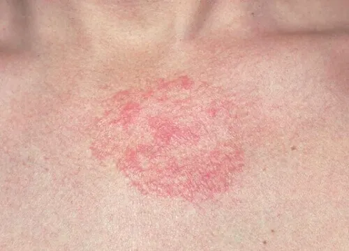 actinodermatosis