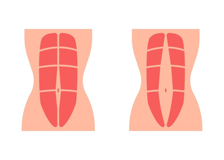 Diástasis abdominal: qué es y cómo se trata