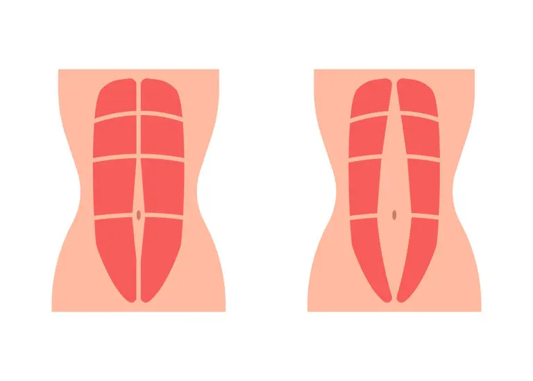 Diástasis abdominal: qué es y cómo se trata