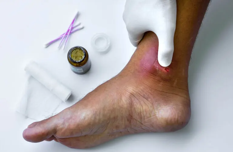 Técnicas para el tratamiento de los abscesos