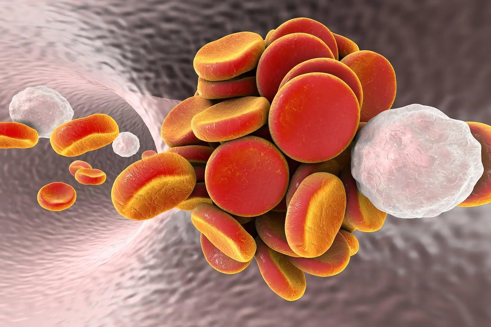 Thromboembolie due à la placentophagie.