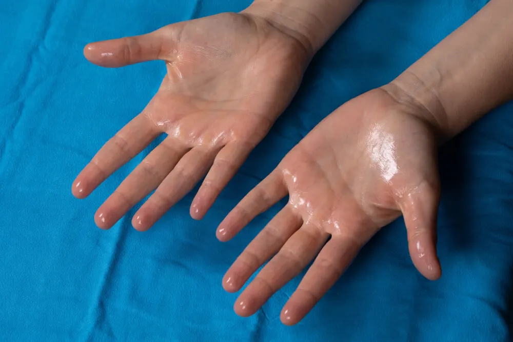 Síntomas de la hiperhidrosis