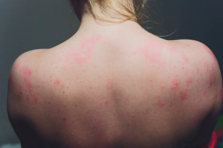 ¿Qué es la actinodermatosis?