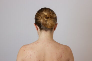 ¿Por qué me salen granos en la espalda?