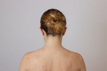 ¿Por qué me salen granos en la espalda?