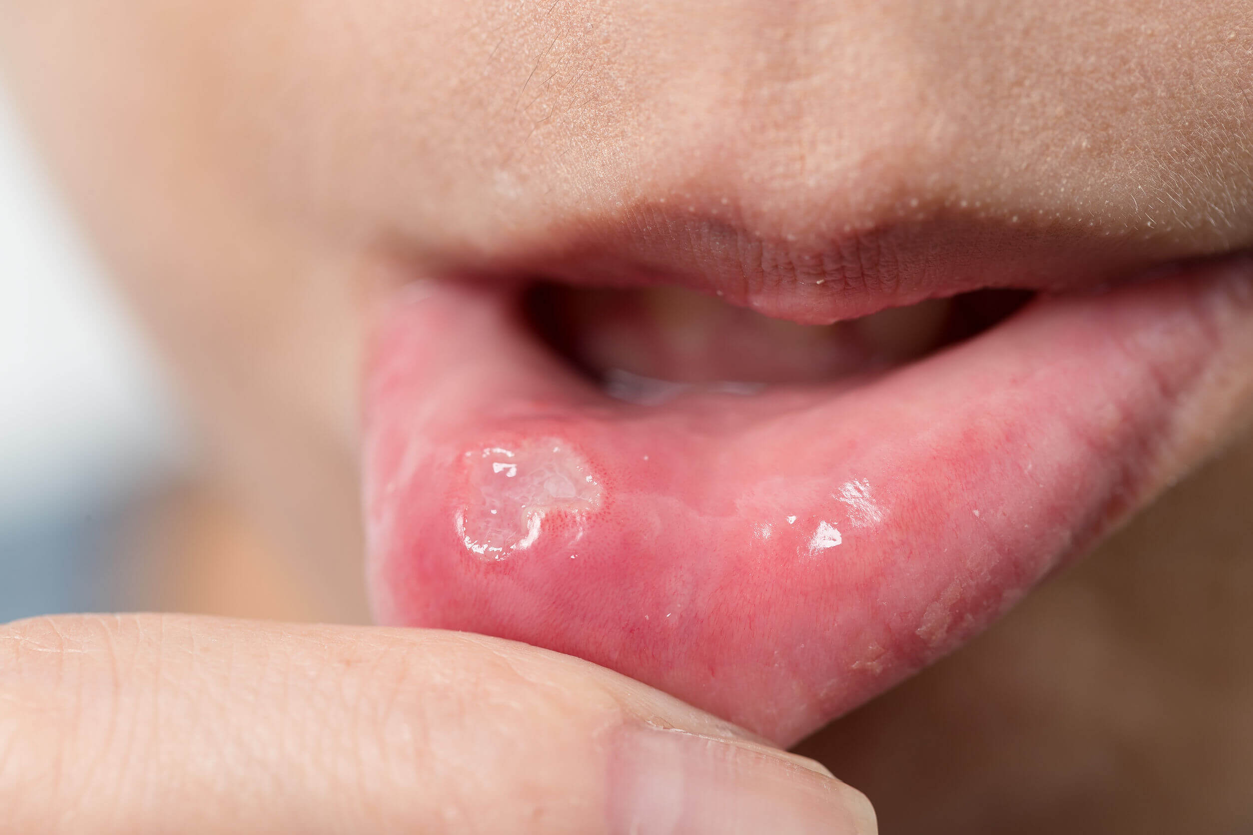 Cómo curar aftas y llagas en boca? - Mejor con Salud