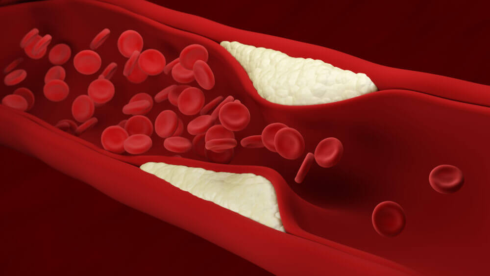 Colesterol elevado en la sangre.