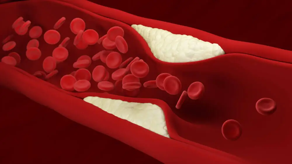 Arteriosclerosis