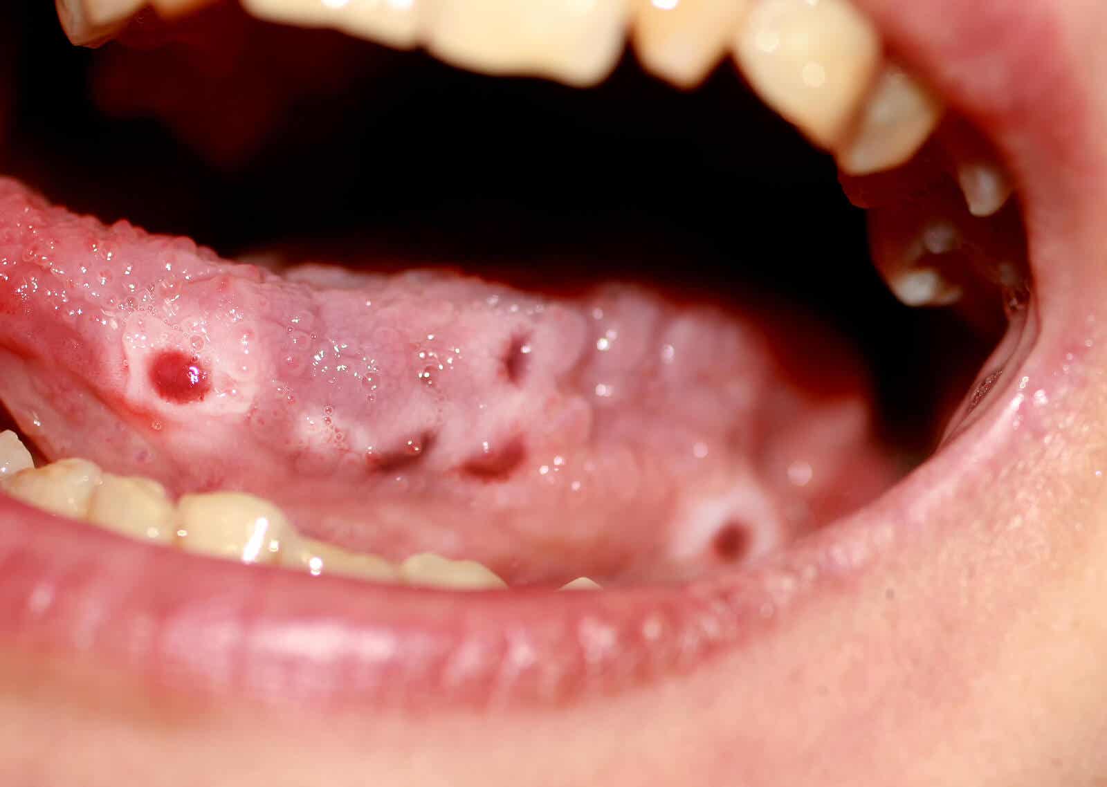 La candidiasis oral es una posible causa de las boqueras.