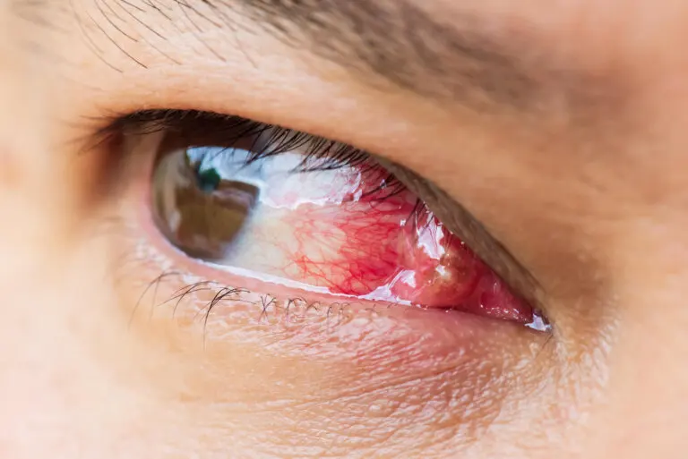 Carnosidad en los ojos: ¿qué es y por qué aparece?