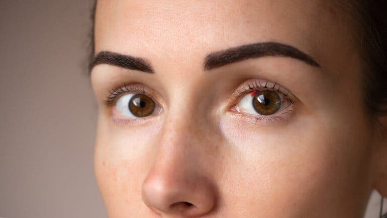 Manchas rojas en los ojos: ¿por qué se producen?