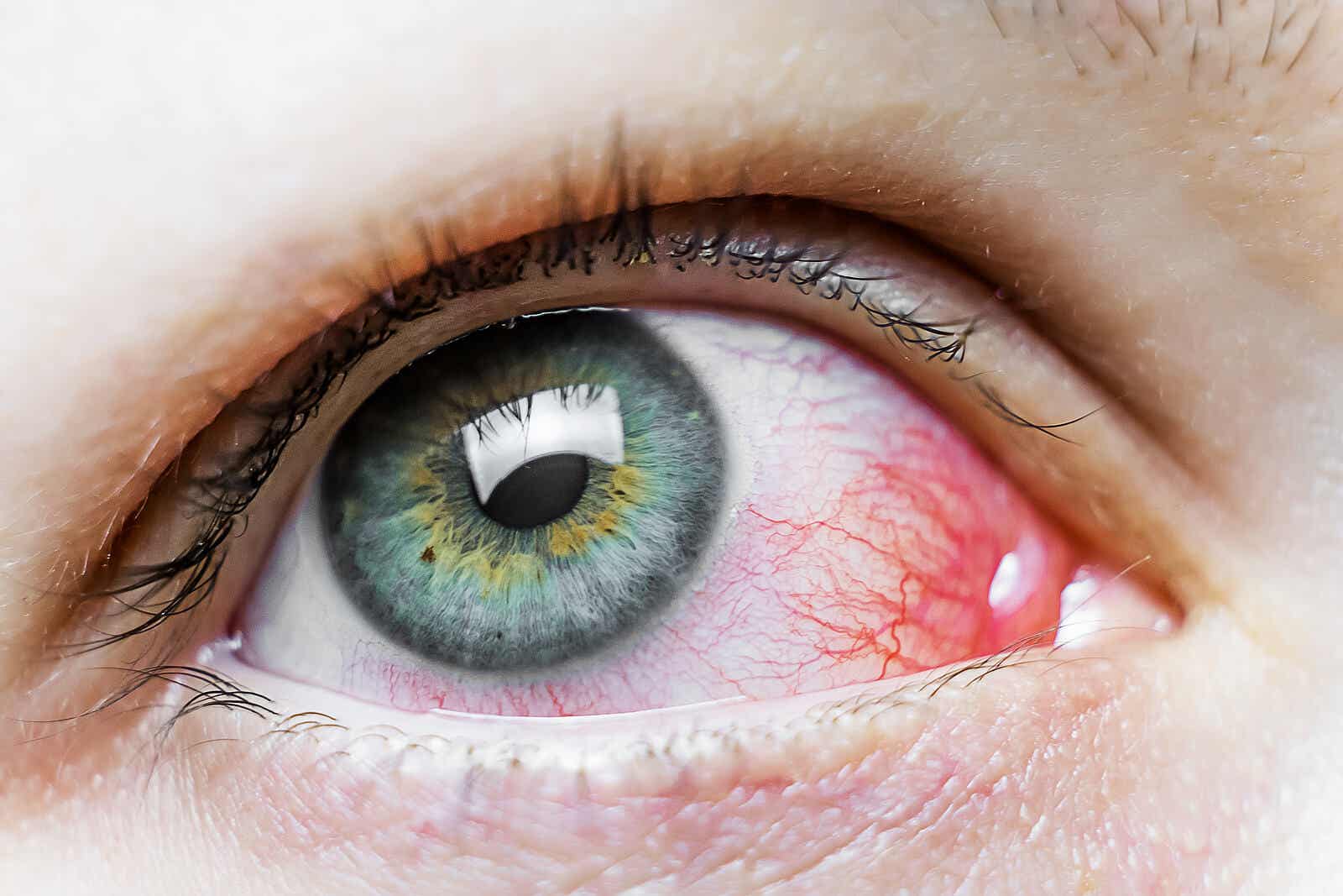 La fatiga visual puede ser una causa de las manchas rojas en los ojos.