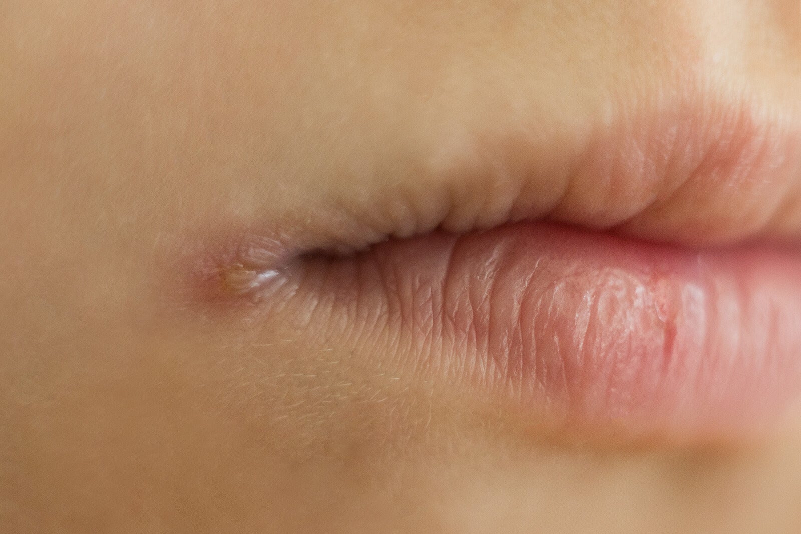 what-foods-cause-angular-cheilitis