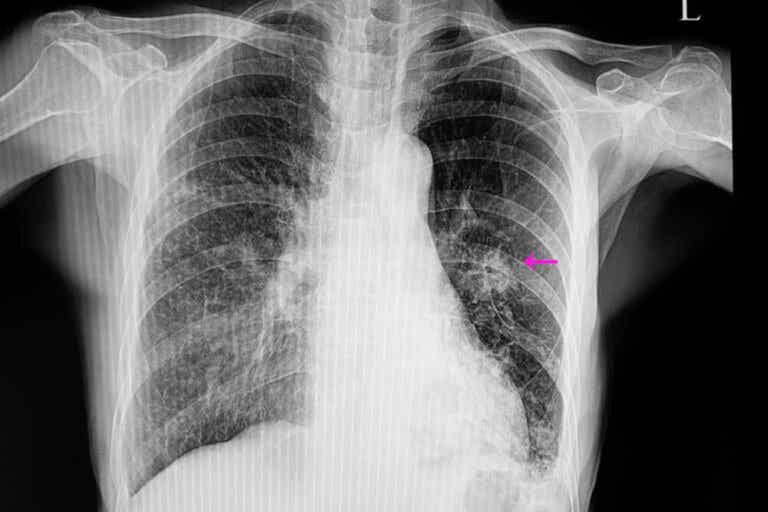 Nódulo pulmonar, ¿qué significa?