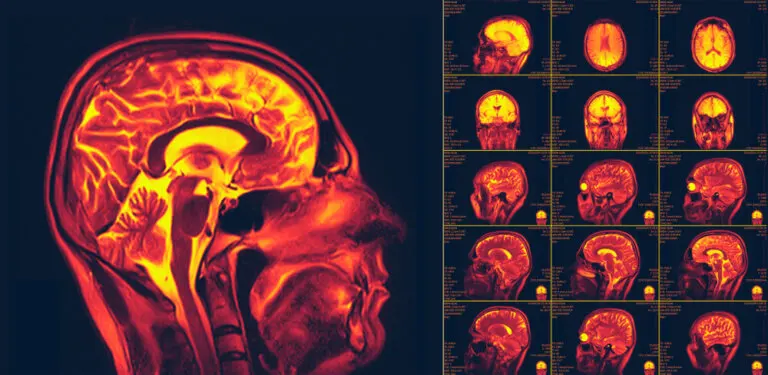 ¿Qué es la neuroplasticidad?