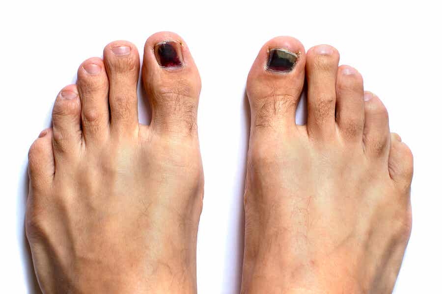 Uñas negras de los pies: ¿cómo tratarlas?