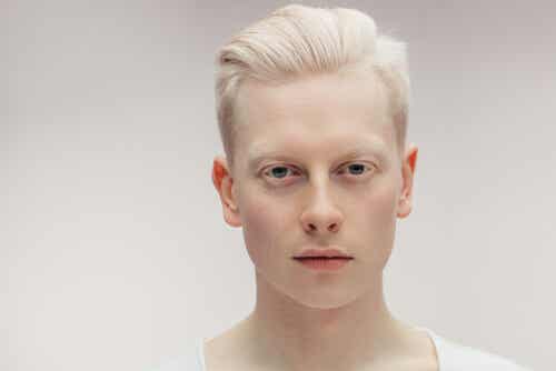 Todo sobre el albinismo