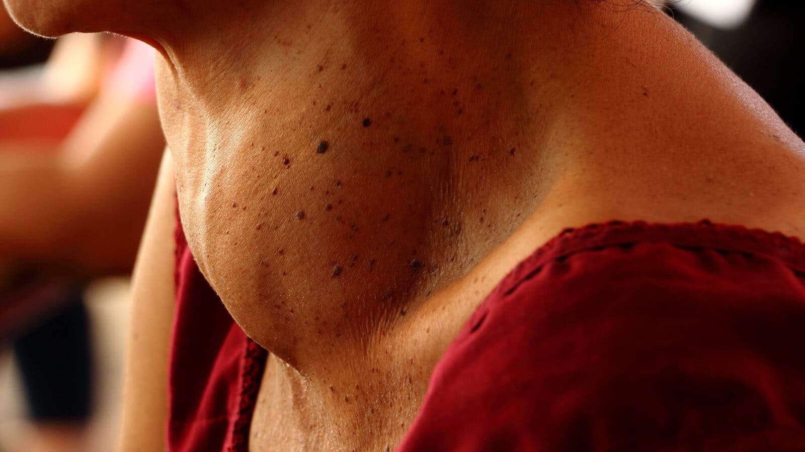 Is het mogelijk om zonder schildklier te leven