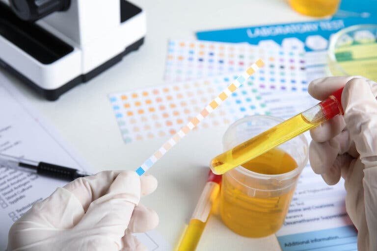 Nefropatía membranosa: ¿qué es y qué la causa?