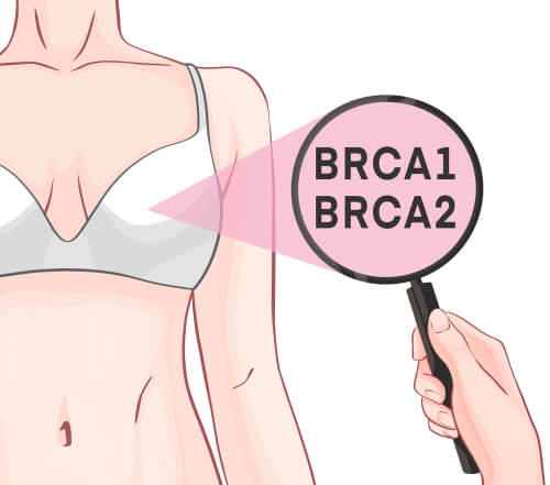 El papel del gen BRCA-1 y BRCA-2 en el cáncer de mama