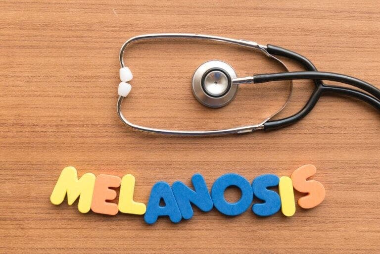 Melanosis del fumador